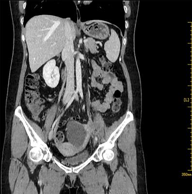 Primary squamous cell carcinoma of the ovary. Review of the literature